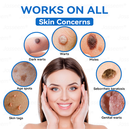 𝐉𝐚𝐬𝐬𝐞𝐞𝐦®👩‍⚕️🎉 𝐍𝐨𝐧-𝐈𝐧𝐯𝐚𝐬𝐢𝐯𝐞 𝐌𝐨𝐥𝐞 & 𝐖𝐚𝐫𝐭 𝐋𝐚𝐬𝐞𝐫 𝐑𝐞𝐦𝐨𝐯𝐚𝐥 𝐏𝐞𝐧 (𝐐𝐮𝐢𝐜𝐤 𝐚𝐧𝐝 𝐩𝐚𝐢𝐧𝐥𝐞𝐬𝐬 𝐫𝐞𝐦𝐨𝐯𝐚𝐥 𝐨𝐟 𝐰𝐚𝐫𝐭𝐬, 𝐦𝐨𝐥𝐞𝐬, 𝐚𝐠𝐞 𝐬𝐩𝐨𝐭𝐬, 𝐚𝐧𝐝 𝐬𝐤𝐢𝐧 𝐭𝐚𝐠𝐬 𝐰𝐢𝐭𝐡 𝐧𝐨 𝐬𝐢𝐝𝐞 𝐞𝐟𝐟𝐞𝐜𝐭𝐬)