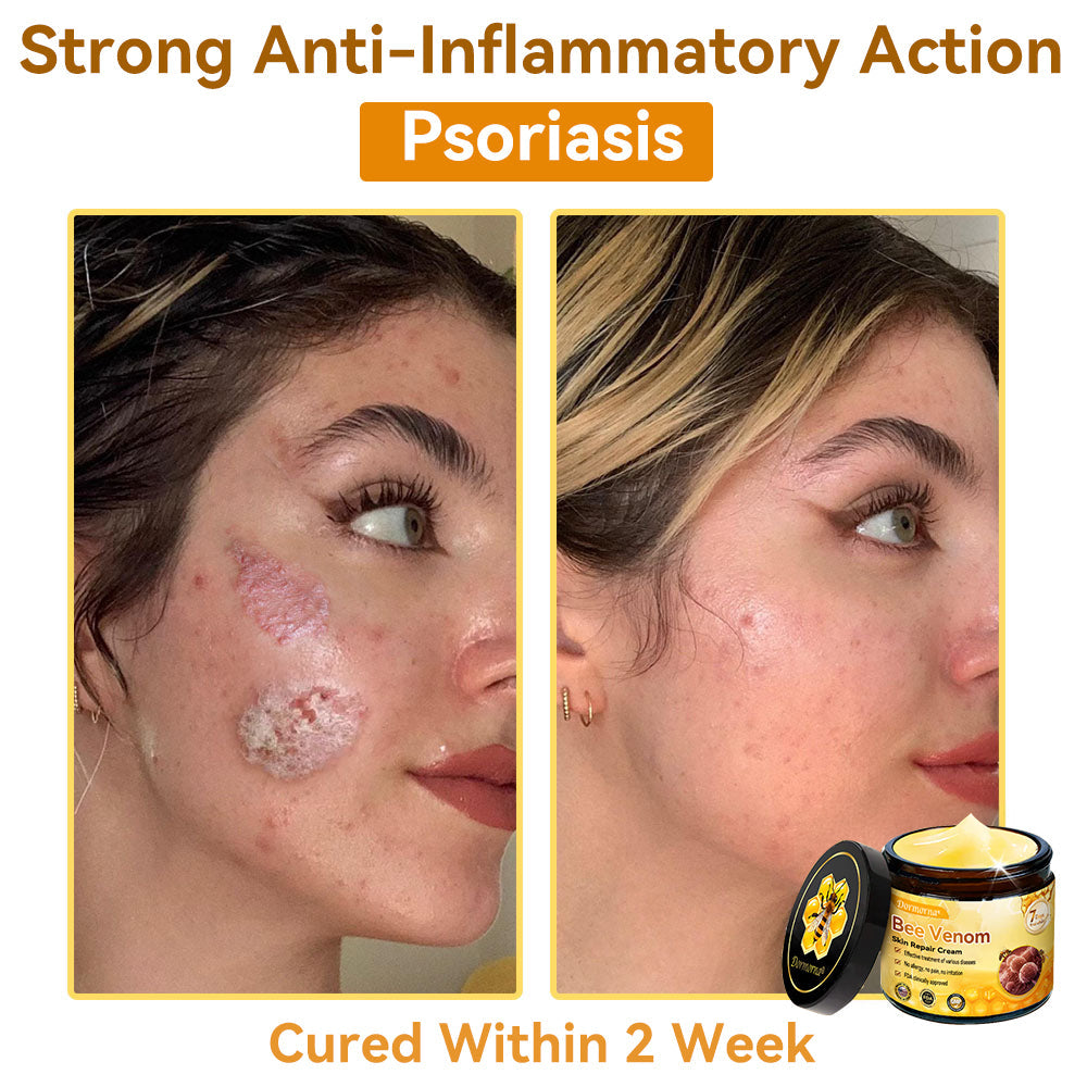 （🚚 Made & Shipped in the USA ✅） 𝐃𝐨𝐫𝐦𝐨𝐫𝐧𝐚® 💕 Bee Venom Repair Cream Last Day – 70% OFF! 🔥