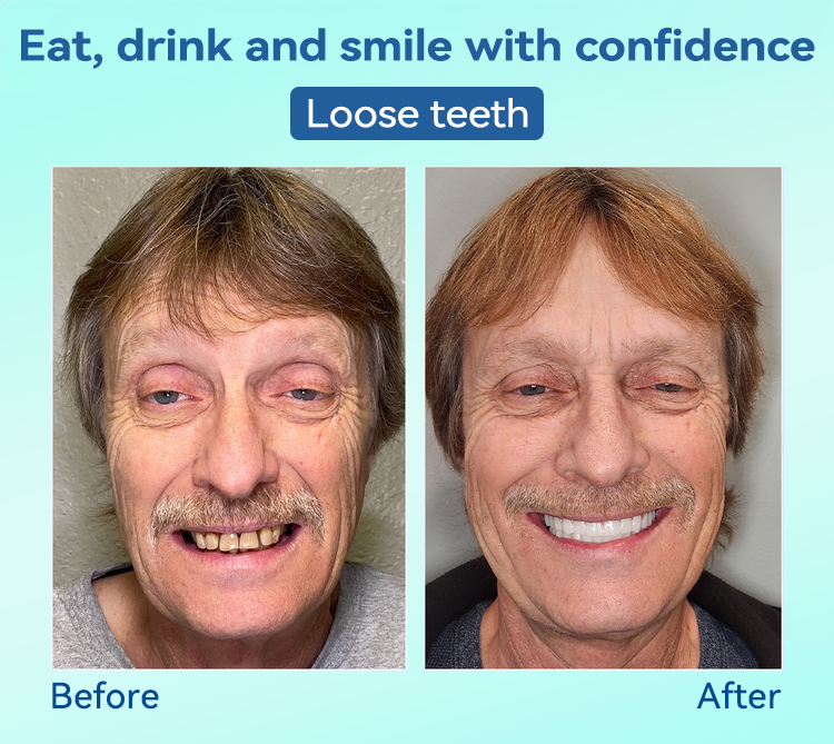 𝐁𝐢𝐤𝐞𝐧𝐝𝐚®✅𝐏𝐫𝐞𝐦𝐢𝐮𝐦 𝐃𝐞𝐧𝐭𝐮𝐫𝐞(🦷𝐋𝐢𝐦𝐢𝐭𝐞𝐝 𝐭𝐢𝐦𝐞 𝐝𝐢𝐬𝐜𝐨𝐮𝐧𝐭 𝐋𝐚𝐬𝐭 𝟑𝟎 𝐦𝐢𝐧𝐮𝐭𝐞𝐬🦷)