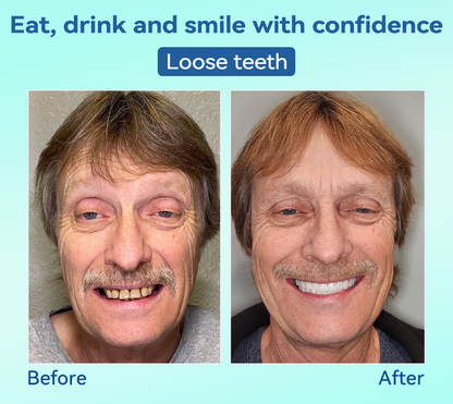 𝐁𝐢𝐤𝐞𝐧𝐝𝐚®✅𝐏𝐫𝐞𝐦𝐢𝐮𝐦 𝐃𝐞𝐧𝐭𝐮𝐫𝐞(🦷𝐋𝐢𝐦𝐢𝐭𝐞𝐝 𝐭𝐢𝐦𝐞 𝐝𝐢𝐬𝐜𝐨𝐮𝐧𝐭 𝐋𝐚𝐬𝐭 𝟑𝟎 𝐦𝐢𝐧𝐮𝐭𝐞𝐬🦷)