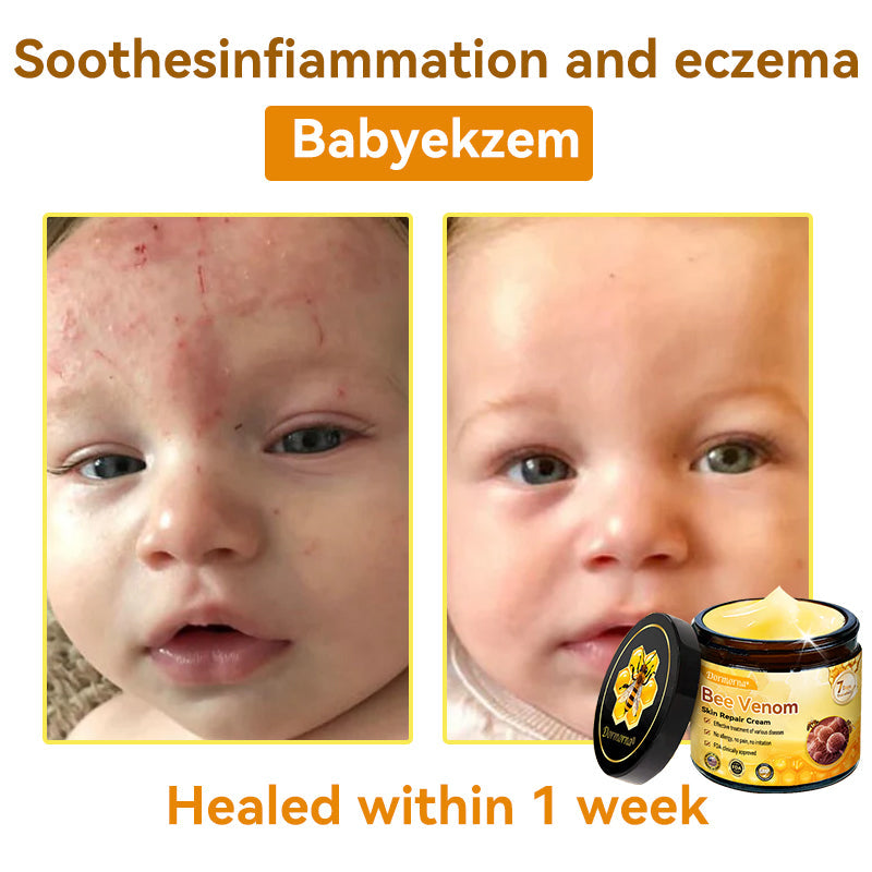 （🚚 Made & Shipped in the USA ✅） 𝐃𝐨𝐫𝐦𝐨𝐫𝐧𝐚® 💕 Bee Venom Repair Cream Last Day – 70% OFF! 🔥