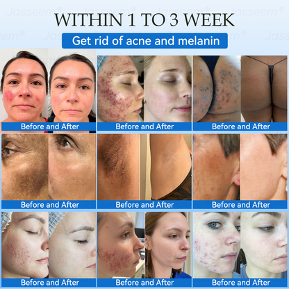 𝐉𝐚𝐬𝐬𝐞𝐞𝐦®👩‍⚕️🎉 𝐍𝐨𝐧-𝐈𝐧𝐯𝐚𝐬𝐢𝐯𝐞 𝐌𝐨𝐥𝐞 & 𝐖𝐚𝐫𝐭 𝐋𝐚𝐬𝐞𝐫 𝐑𝐞𝐦𝐨𝐯𝐚𝐥 𝐏𝐞𝐧 (𝐐𝐮𝐢𝐜𝐤 𝐚𝐧𝐝 𝐩𝐚𝐢𝐧𝐥𝐞𝐬𝐬 𝐫𝐞𝐦𝐨𝐯𝐚𝐥 𝐨𝐟 𝐰𝐚𝐫𝐭𝐬, 𝐦𝐨𝐥𝐞𝐬, 𝐚𝐠𝐞 𝐬𝐩𝐨𝐭𝐬, 𝐚𝐧𝐝 𝐬𝐤𝐢𝐧 𝐭𝐚𝐠𝐬 𝐰𝐢𝐭𝐡 𝐧𝐨 𝐬𝐢𝐝𝐞 𝐞𝐟𝐟𝐞𝐜𝐭𝐬)
