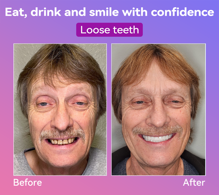 𝐉𝐚𝐬𝐬𝐞𝐞𝐦® Latest Premium Comfort Dentures🌌(High-End Dentures, Easy to Wear - Limited Time 70% Discount)