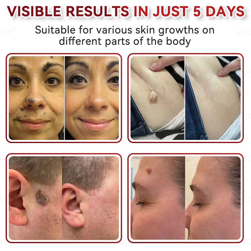 𝑉𝑠𝑜𝑥𝑎® 💧Microneedles Botanical Skin Tags Solution Patches - Made in the USA