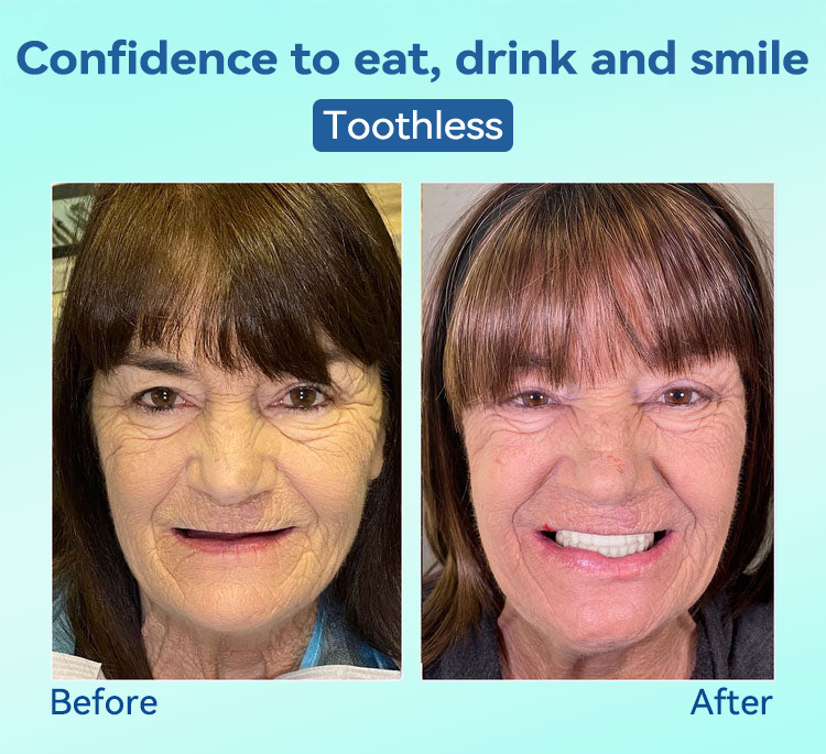 𝐁𝐢𝐤𝐞𝐧𝐝𝐚®✅𝐏𝐫𝐞𝐦𝐢𝐮𝐦 𝐃𝐞𝐧𝐭𝐮𝐫𝐞(🦷𝐋𝐢𝐦𝐢𝐭𝐞𝐝 𝐭𝐢𝐦𝐞 𝐝𝐢𝐬𝐜𝐨𝐮𝐧𝐭 𝐋𝐚𝐬𝐭 𝟑𝟎 𝐦𝐢𝐧𝐮𝐭𝐞𝐬🦷)