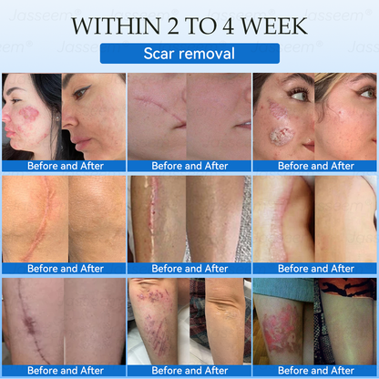 𝐉𝐚𝐬𝐬𝐞𝐞𝐦®👩‍⚕️🎉 𝐍𝐨𝐧-𝐈𝐧𝐯𝐚𝐬𝐢𝐯𝐞 𝐌𝐨𝐥𝐞 & 𝐖𝐚𝐫𝐭 𝐋𝐚𝐬𝐞𝐫 𝐑𝐞𝐦𝐨𝐯𝐚𝐥 𝐏𝐞𝐧 (𝐐𝐮𝐢𝐜𝐤 𝐚𝐧𝐝 𝐩𝐚𝐢𝐧𝐥𝐞𝐬𝐬 𝐫𝐞𝐦𝐨𝐯𝐚𝐥 𝐨𝐟 𝐰𝐚𝐫𝐭𝐬, 𝐦𝐨𝐥𝐞𝐬, 𝐚𝐠𝐞 𝐬𝐩𝐨𝐭𝐬, 𝐚𝐧𝐝 𝐬𝐤𝐢𝐧 𝐭𝐚𝐠𝐬 𝐰𝐢𝐭𝐡 𝐧𝐨 𝐬𝐢𝐝𝐞 𝐞𝐟𝐟𝐞𝐜𝐭𝐬)