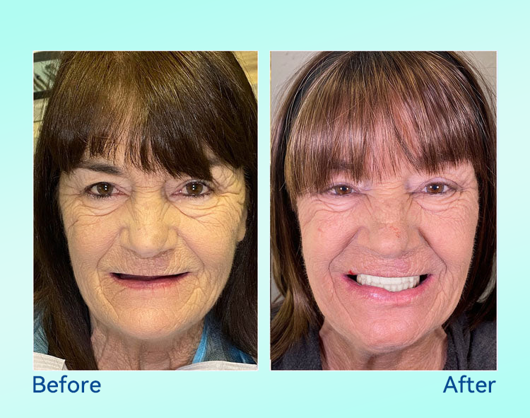 🔥 Only 4 boxes left! Enjoy an extra 50% off! Recommended by dentists, 🍀𝐁𝐢𝐤𝐞𝐧𝐝𝐚® ensures your oral health so you can enjoy meals safely and naturally. Don’t miss out—act now or wait until next year! Enhance your oral health today!