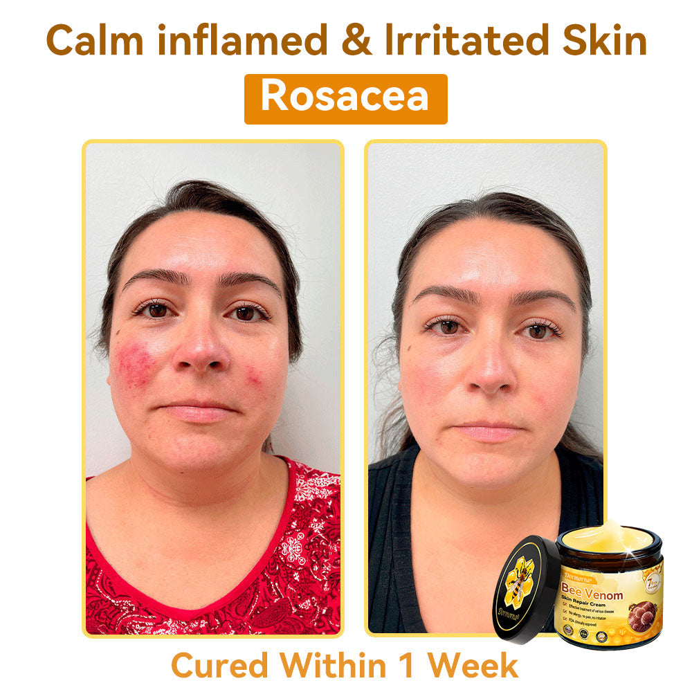 （🚚 Made & Shipped in the USA ✅） 𝐃𝐨𝐫𝐦𝐨𝐫𝐧𝐚® 💕 Bee Venom Repair Cream Last Day – 70% OFF! 🔥