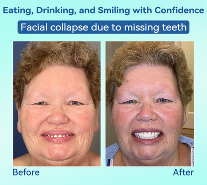 𝐁𝐢𝐤𝐞𝐧𝐝𝐚®✅𝐏𝐫𝐞𝐦𝐢𝐮𝐦 𝐃𝐞𝐧𝐭𝐮𝐫𝐞(🦷𝐋𝐢𝐦𝐢𝐭𝐞𝐝 𝐭𝐢𝐦𝐞 𝐝𝐢𝐬𝐜𝐨𝐮𝐧𝐭 𝐋𝐚𝐬𝐭 𝟑𝟎 𝐦𝐢𝐧𝐮𝐭𝐞𝐬🦷)