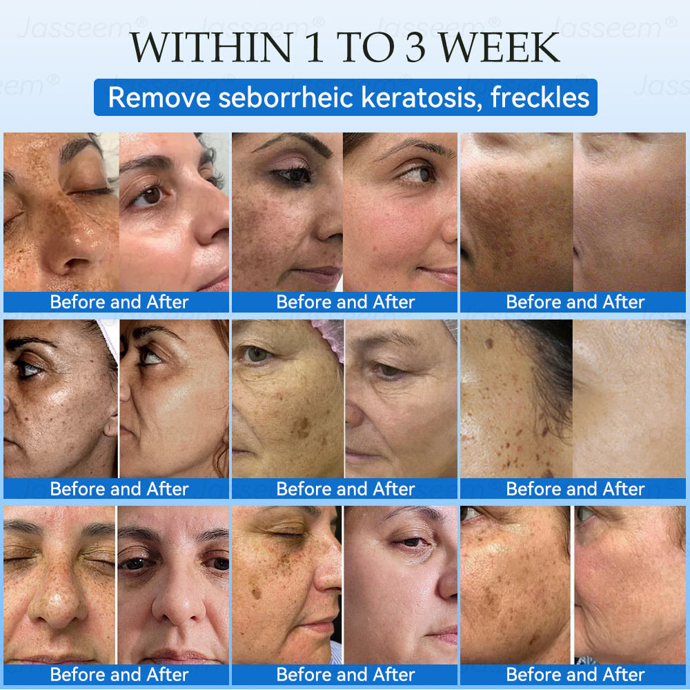 𝐉𝐚𝐬𝐬𝐞𝐞𝐦®👩‍⚕️🎉 𝐍𝐨𝐧-𝐈𝐧𝐯𝐚𝐬𝐢𝐯𝐞 𝐌𝐨𝐥𝐞 & 𝐖𝐚𝐫𝐭 𝐋𝐚𝐬𝐞𝐫 𝐑𝐞𝐦𝐨𝐯𝐚𝐥 𝐏𝐞𝐧 (𝐐𝐮𝐢𝐜𝐤 𝐚𝐧𝐝 𝐩𝐚𝐢𝐧𝐥𝐞𝐬𝐬 𝐫𝐞𝐦𝐨𝐯𝐚𝐥 𝐨𝐟 𝐰𝐚𝐫𝐭𝐬, 𝐦𝐨𝐥𝐞𝐬, 𝐚𝐠𝐞 𝐬𝐩𝐨𝐭𝐬, 𝐚𝐧𝐝 𝐬𝐤𝐢𝐧 𝐭𝐚𝐠𝐬 𝐰𝐢𝐭𝐡 𝐧𝐨 𝐬𝐢𝐝𝐞 𝐞𝐟𝐟𝐞𝐜𝐭𝐬)