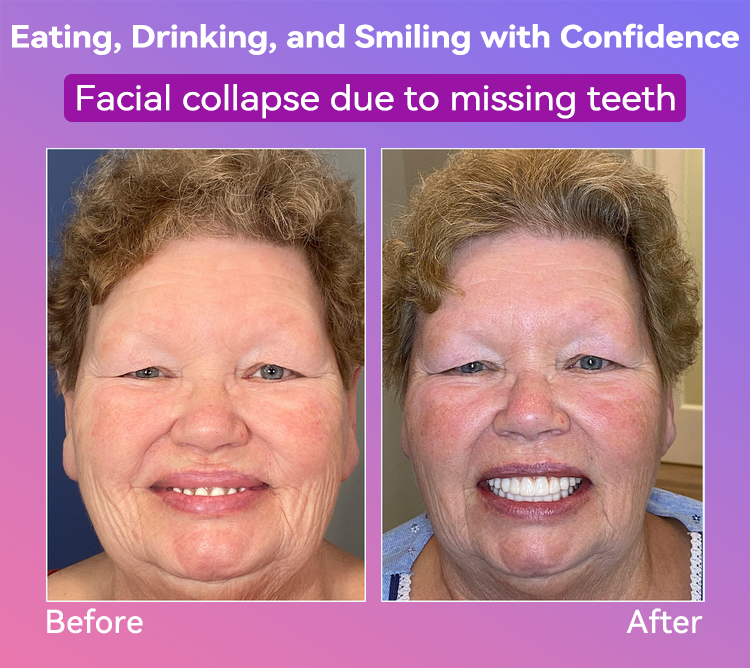 𝐉𝐚𝐬𝐬𝐞𝐞𝐦® Latest Premium Comfort Dentures🌌(High-End Dentures, Easy to Wear - Limited Time 70% Discount)