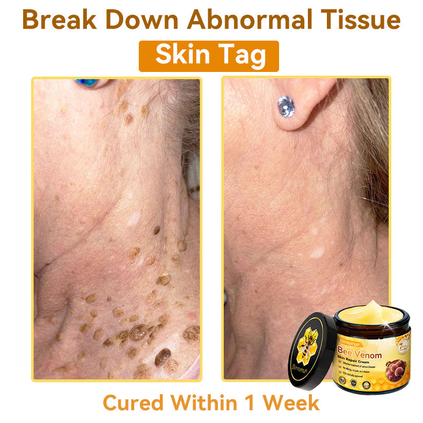 （🚚 Made & Shipped in the USA ✅） 𝐃𝐨𝐫𝐦𝐨𝐫𝐧𝐚® 💕 Bee Venom Repair Cream Last Day – 70% OFF! 🔥