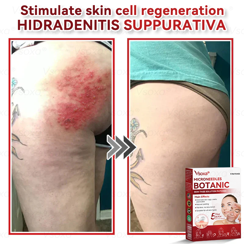 𝑉𝑠𝑜𝑥𝑎® 💧Microneedles Botanical Skin Tags Solution Patches - Made in the USA