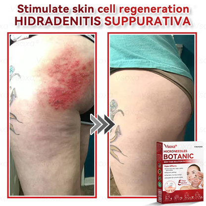 𝑉𝑠𝑜𝑥𝑎® 💧Microneedles Botanical Skin Tags Solution Patches - Made in the USA
