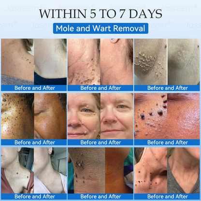 𝐉𝐚𝐬𝐬𝐞𝐞𝐦® 𝐍𝐨𝐧-𝐈𝐧𝐯𝐚𝐬𝐢𝐯𝐞 𝐌𝐨𝐥𝐞 & 𝐖𝐚𝐫𝐭 𝐋𝐚𝐬𝐞𝐫 𝐑𝐞𝐦𝐨𝐯𝐚𝐥 𝐏𝐞𝐧 (𝐐𝐮𝐢𝐜𝐤 𝐚𝐧𝐝 𝐩𝐚𝐢𝐧𝐥𝐞𝐬𝐬 𝐫𝐞𝐦𝐨𝐯𝐚𝐥 𝐨𝐟 𝐰𝐚𝐫𝐭𝐬, 𝐦𝐨𝐥𝐞𝐬, 𝐚𝐠𝐞 𝐬𝐩𝐨𝐭𝐬, 𝐚𝐧𝐝 𝐬𝐤𝐢𝐧 𝐭𝐚𝐠𝐬 𝐰𝐢𝐭𝐡 𝐧𝐨 𝐬𝐢𝐝𝐞 𝐞𝐟𝐟𝐞𝐜𝐭𝐬)
