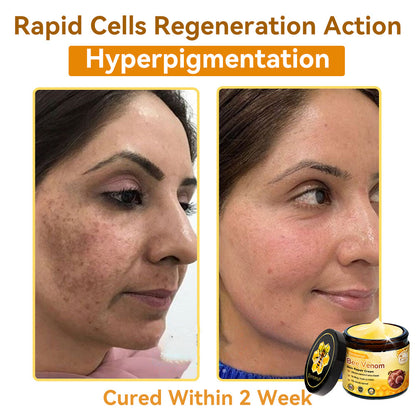 （🚚 Made & Shipped in the USA ✅） 𝐃𝐨𝐫𝐦𝐨𝐫𝐧𝐚® 💕 Bee Venom Repair Cream Last Day – 70% OFF! 🔥