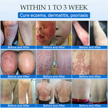 𝐉𝐚𝐬𝐬𝐞𝐞𝐦®👩‍⚕️🎉 𝐍𝐨𝐧-𝐈𝐧𝐯𝐚𝐬𝐢𝐯𝐞 𝐌𝐨𝐥𝐞 & 𝐖𝐚𝐫𝐭 𝐋𝐚𝐬𝐞𝐫 𝐑𝐞𝐦𝐨𝐯𝐚𝐥 𝐏𝐞𝐧 (𝐐𝐮𝐢𝐜𝐤 𝐚𝐧𝐝 𝐩𝐚𝐢𝐧𝐥𝐞𝐬𝐬 𝐫𝐞𝐦𝐨𝐯𝐚𝐥 𝐨𝐟 𝐰𝐚𝐫𝐭𝐬, 𝐦𝐨𝐥𝐞𝐬, 𝐚𝐠𝐞 𝐬𝐩𝐨𝐭𝐬, 𝐚𝐧𝐝 𝐬𝐤𝐢𝐧 𝐭𝐚𝐠𝐬 𝐰𝐢𝐭𝐡 𝐧𝐨 𝐬𝐢𝐝𝐞 𝐞𝐟𝐟𝐞𝐜𝐭𝐬)