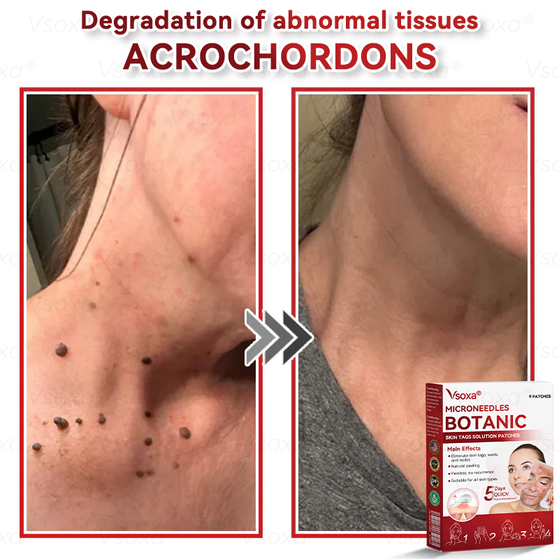 🛡️ 𝑉𝑠𝑜𝑥𝑎®  Microneedle Botanical Skin Tag Repair Patches 🎁🎁