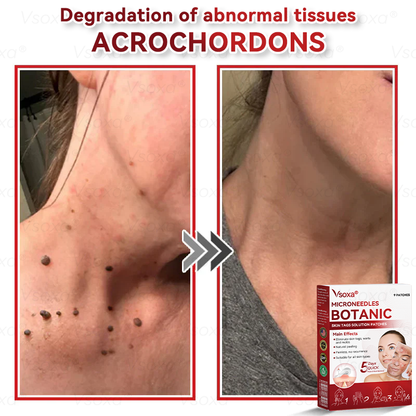 𝑉𝑠𝑜𝑥𝑎® 💧Microneedles Botanical Skin Tags Solution Patches - Made in the USA
