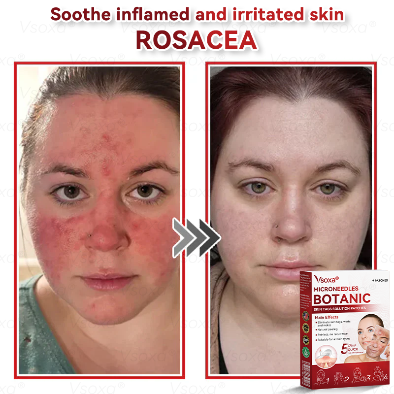 🛡️ 𝑉𝑠𝑜𝑥𝑎®  Microneedle Botanical Skin Tag Repair Patches 🎁🎁