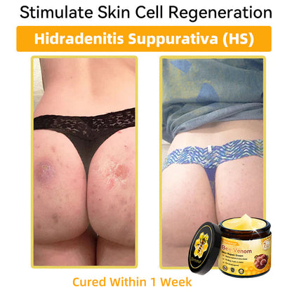 （🚚 Made & Shipped in the USA ✅） 𝐃𝐨𝐫𝐦𝐨𝐫𝐧𝐚® 💕 Bee Venom Repair Cream Last Day – 70% OFF! 🔥