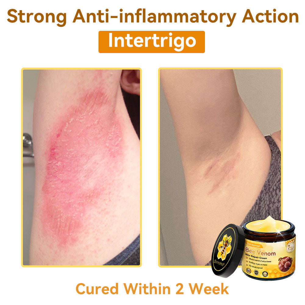 （🚚 Made & Shipped in the USA ✅） 𝐃𝐨𝐫𝐦𝐨𝐫𝐧𝐚® 💕 Bee Venom Repair Cream Last Day – 70% OFF! 🔥