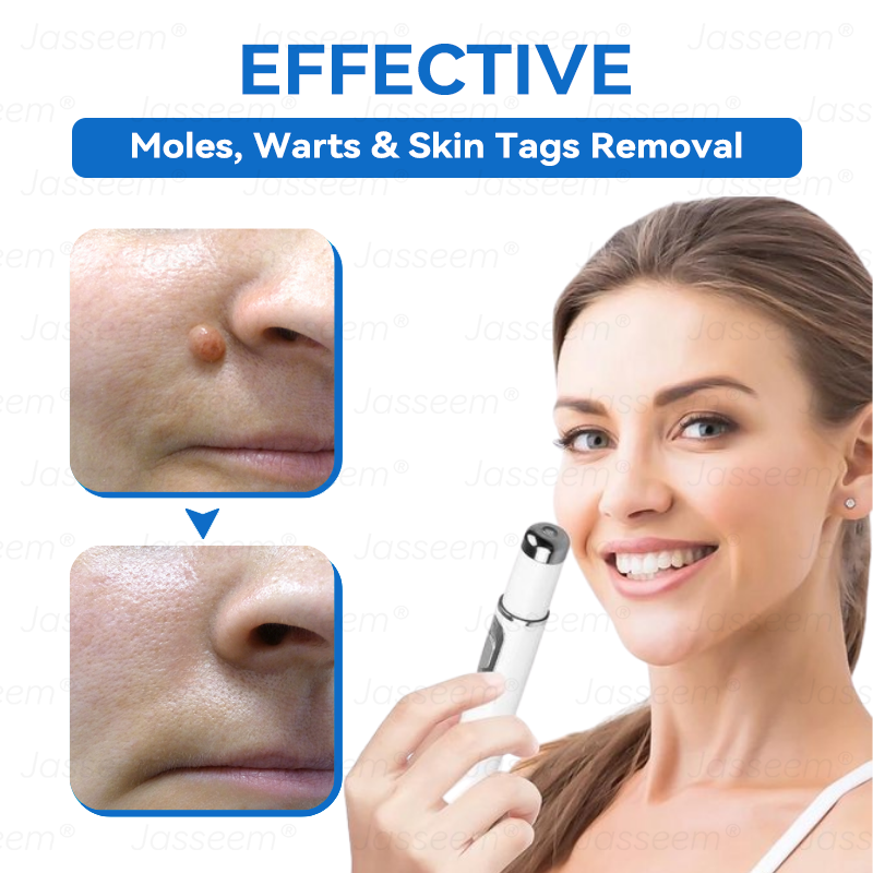 𝐉𝐚𝐬𝐬𝐞𝐞𝐦® 𝐍𝐨𝐧-𝐈𝐧𝐯𝐚𝐬𝐢𝐯𝐞 𝐌𝐨𝐥𝐞 & 𝐖𝐚𝐫𝐭 𝐋𝐚𝐬𝐞𝐫 𝐑𝐞𝐦𝐨𝐯𝐚𝐥 𝐏𝐞𝐧 (𝐐𝐮𝐢𝐜𝐤 𝐚𝐧𝐝 𝐩𝐚𝐢𝐧𝐥𝐞𝐬𝐬 𝐫𝐞𝐦𝐨𝐯𝐚𝐥 𝐨𝐟 𝐰𝐚𝐫𝐭𝐬, 𝐦𝐨𝐥𝐞𝐬, 𝐚𝐠𝐞 𝐬𝐩𝐨𝐭𝐬, 𝐚𝐧𝐝 𝐬𝐤𝐢𝐧 𝐭𝐚𝐠𝐬 𝐰𝐢𝐭𝐡 𝐧𝐨 𝐬𝐢𝐝𝐞 𝐞𝐟𝐟𝐞𝐜𝐭𝐬)