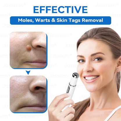 𝐉𝐚𝐬𝐬𝐞𝐞𝐦® 𝐍𝐨𝐧-𝐈𝐧𝐯𝐚𝐬𝐢𝐯𝐞 𝐌𝐨𝐥𝐞 & 𝐖𝐚𝐫𝐭 𝐋𝐚𝐬𝐞𝐫 𝐑𝐞𝐦𝐨𝐯𝐚𝐥 𝐏𝐞𝐧 (𝐐𝐮𝐢𝐜𝐤 𝐚𝐧𝐝 𝐩𝐚𝐢𝐧𝐥𝐞𝐬𝐬 𝐫𝐞𝐦𝐨𝐯𝐚𝐥 𝐨𝐟 𝐰𝐚𝐫𝐭𝐬, 𝐦𝐨𝐥𝐞𝐬, 𝐚𝐠𝐞 𝐬𝐩𝐨𝐭𝐬, 𝐚𝐧𝐝 𝐬𝐤𝐢𝐧 𝐭𝐚𝐠𝐬 𝐰𝐢𝐭𝐡 𝐧𝐨 𝐬𝐢𝐝𝐞 𝐞𝐟𝐟𝐞𝐜𝐭𝐬)
