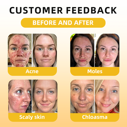 𝓕𝓪𝓽𝓸𝓷𝓰® Bee Venom Skin Repair Essence Ampoules 💕(Effectively improves moles, warts, skin tags, dark spots, and other skin imperfections)