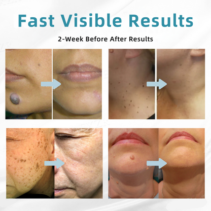 𝐉𝐚𝐬𝐬𝐞𝐞𝐦® Medical-Grade Laser Pen 🎉 (Powered by CO₂ laser technology – effectively removes moles, warts, skin tags, pigmentation spots, and other skin imperfections)🔥