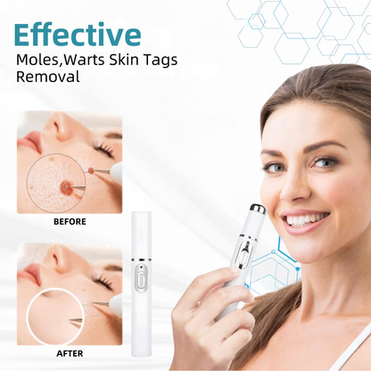 𝐉𝐚𝐬𝐬𝐞𝐞𝐦® Medical-Grade Laser Pen 🎉 (Powered by CO₂ laser technology – effectively removes moles, warts, skin tags, pigmentation spots, and other skin imperfections)🏆