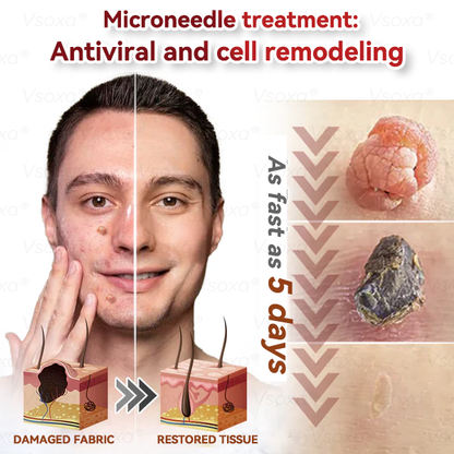 𝑉𝑠𝑜𝑥𝑎® 💧Microneedles Botanical Skin Tags Solution Patches - Made in the USA