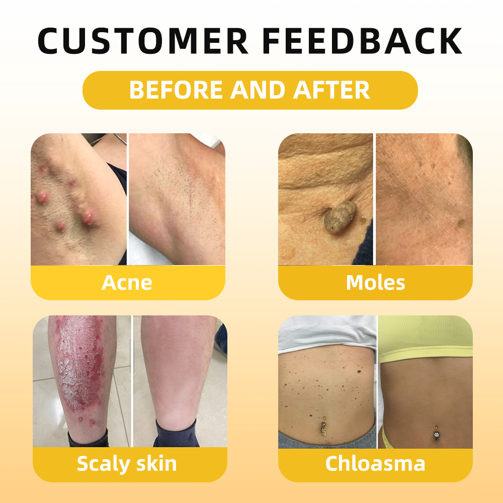 𝓕𝓪𝓽𝓸𝓷𝓰® Bee Venom Skin Repair Essence Ampoules 💕(Effectively improves moles, warts, skin tags, dark spots, and other skin imperfections)