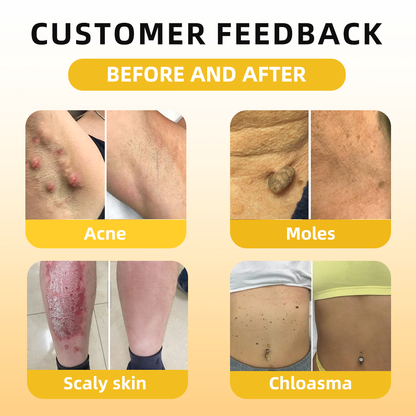 𝓕𝓪𝓽𝓸𝓷𝓰® Bee Venom Skin Repair Essence Ampoules 💕(Effectively improves moles, warts, skin tags, dark spots, and other skin imperfections)