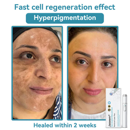 𝐉𝐚𝐬𝐬𝐞𝐞𝐦® Medical-Grade Laser Pen 🎉 (Powered by CO₂ laser technology – effectively removes moles, warts, skin tags, pigmentation spots, and other skin imperfections)🏆