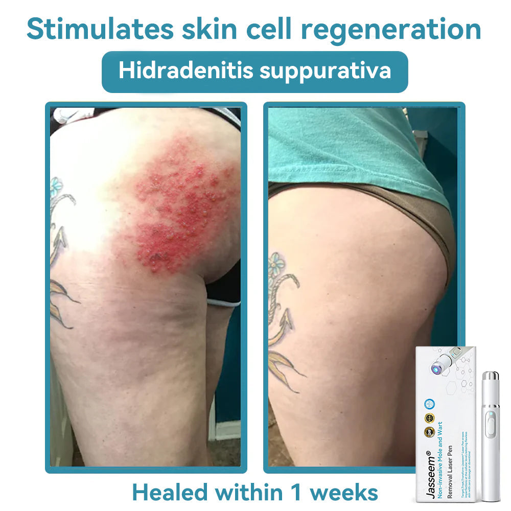 𝐉𝐚𝐬𝐬𝐞𝐞𝐦® Medical-Grade Laser Pen 🎉 (Powered by CO₂ laser technology – effectively removes moles, warts, skin tags, pigmentation spots, and other skin imperfections)🏆