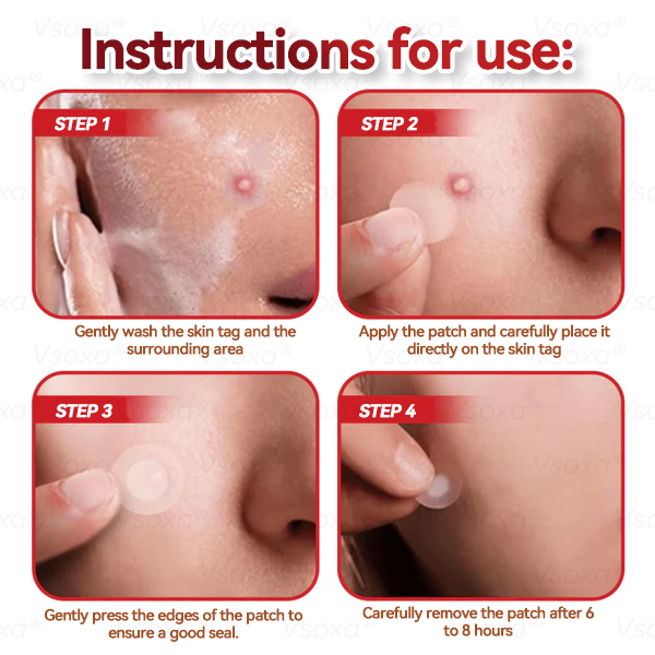 𝑉𝑠𝑜𝑥𝑎® 💧Microneedles Botanical Skin Tags Solution Patches - Made in the USA