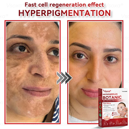 𝑉𝑠𝑜𝑥𝑎® 💧Microneedles Botanical Skin Tags Solution Patches - Made in the USA