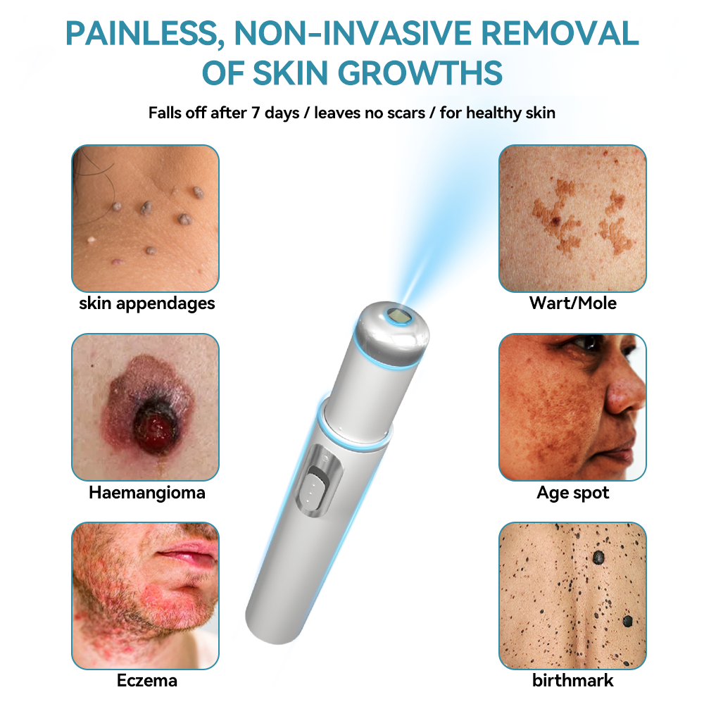 𝐉𝐚𝐬𝐬𝐞𝐞𝐦® 💛Non-invasive Mole and Wart Removal Laser Pen (Quick and painless removal of warts, moles, age spots and skin tags - without any side effects)
