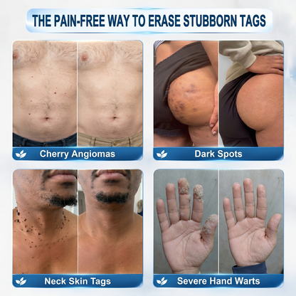 Official Store | 🎉🎁 𝐏i𝐜𝐝o® 7-Day Skin Tag & Spot Remover Serum (Painless, Scar-Free, Roll-On) 🔥