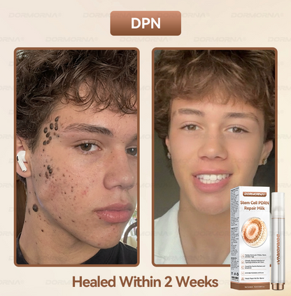 𝐷𝑂𝑅𝑀𝑂𝑅𝑁𝐴® 💕 Stem Cell PDRN Repair Milk | With 2000PPM Exosome‑Coated Micro‑Spicules 👩‍⚕️