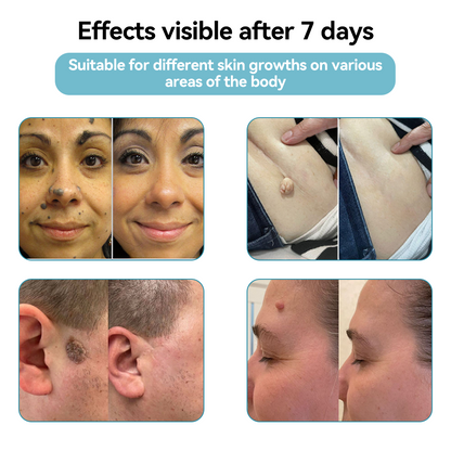 𝐉𝐚𝐬𝐬𝐞𝐞𝐦® Medical-Grade Laser Pen 🎉 (Powered by CO₂ laser technology – effectively removes moles, warts, skin tags, pigmentation spots, and other skin imperfections)🔥