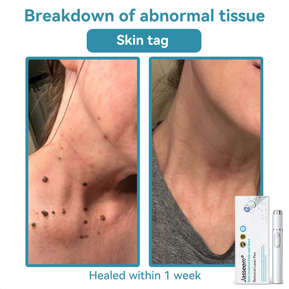 𝐉𝐚𝐬𝐬𝐞𝐞𝐦® Medical-Grade Laser Pen 🎉 (Powered by CO₂ laser technology – effectively removes moles, warts, skin tags, pigmentation spots, and other skin imperfections)🔥