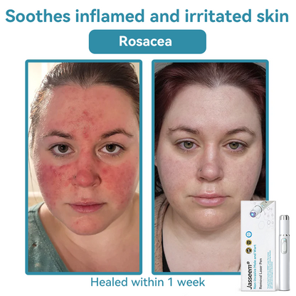 𝐉𝐚𝐬𝐬𝐞𝐞𝐦® Medical-Grade Laser Pen 🎉 (Powered by CO₂ laser technology – effectively removes moles, warts, skin tags, pigmentation spots, and other skin imperfections)🏆