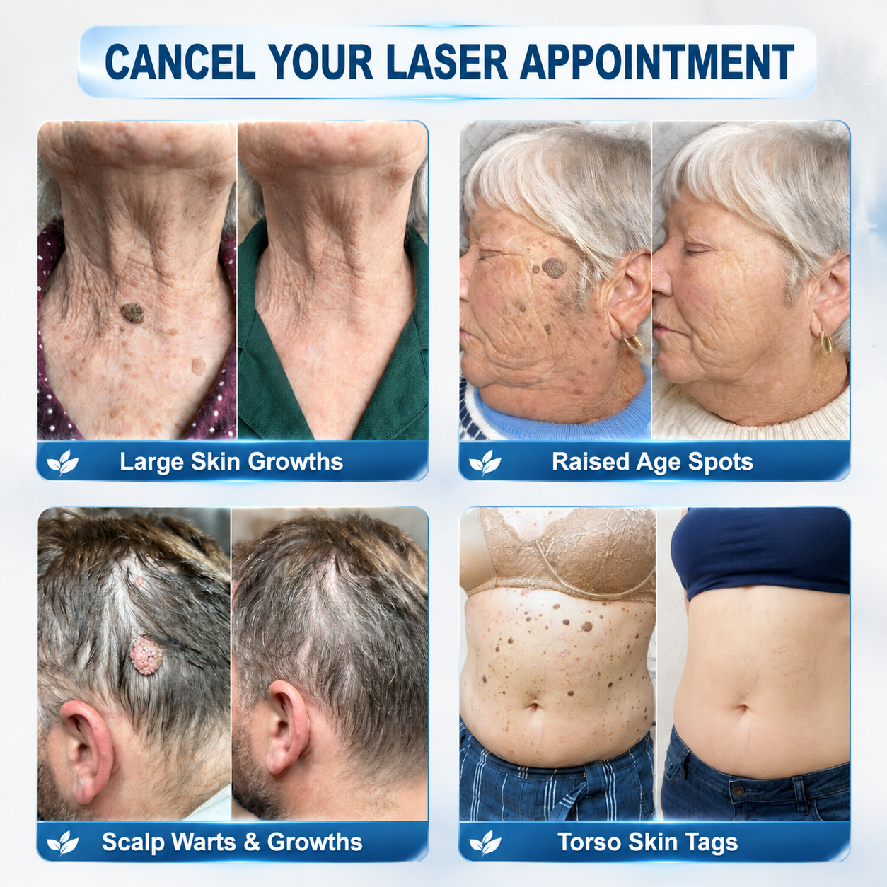 Official Store | 🎉🎁 𝐏i𝐜𝐝o® 7-Day Skin Tag & Spot Remover Serum (Painless, Scar-Free, Roll-On) 🔥