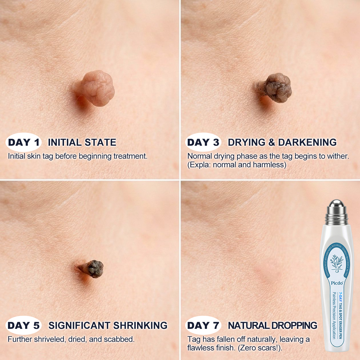 Official Store | 🎉🎁 𝐏i𝐜𝐝o® 7-Day Skin Tag & Spot Remover Serum (Painless, Scar-Free, Roll-On) 🔥