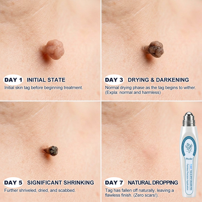 Official Store | 🎉🎁 𝐏i𝐜𝐝o® 7-Day Skin Tag & Spot Remover Serum (Painless, Scar-Free, Roll-On) 🔥