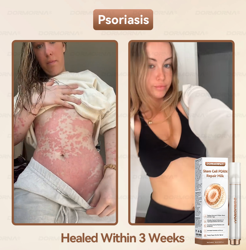 𝐷𝑂𝑅𝑀𝑂𝑅𝑁𝐴® 💕 Stem Cell PDRN Repair Milk | With 2000PPM Exosome‑Coated Micro‑Spicules 👩‍⚕️