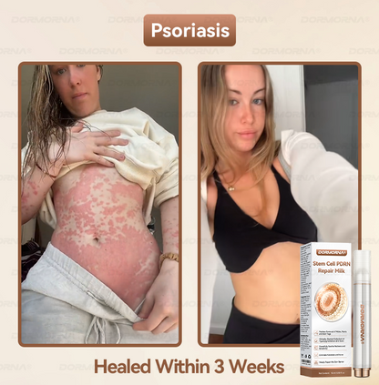 𝐷𝑂𝑅𝑀𝑂𝑅𝑁𝐴® 💕 Stem Cell PDRN Repair Milk | With 2000PPM Exosome‑Coated Micro‑Spicules 👩‍⚕️