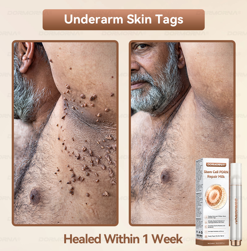 𝐷𝑂𝑅𝑀𝑂𝑅𝑁𝐴® 💕 Stem Cell PDRN Repair Milk | With 2000PPM Exosome‑Coated Micro‑Spicules 👩‍⚕️
